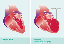 Dilated heart