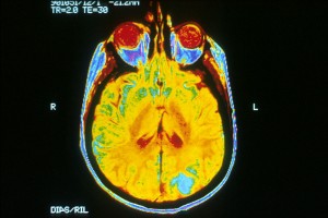 An image of a human brain from a MRI. The blue color is where the brain tumor is located. 