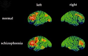 schizophrenia